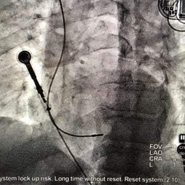 LBB pacing